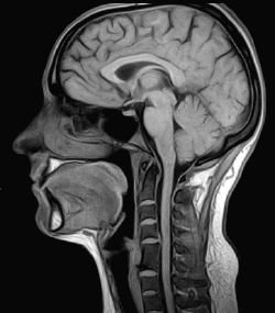 뇌·신경 정상 뇌 MRI